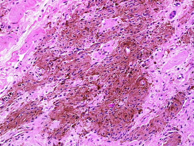 SoftTissue_Neurofibroma9_Pigmented in NF1(1).jpg